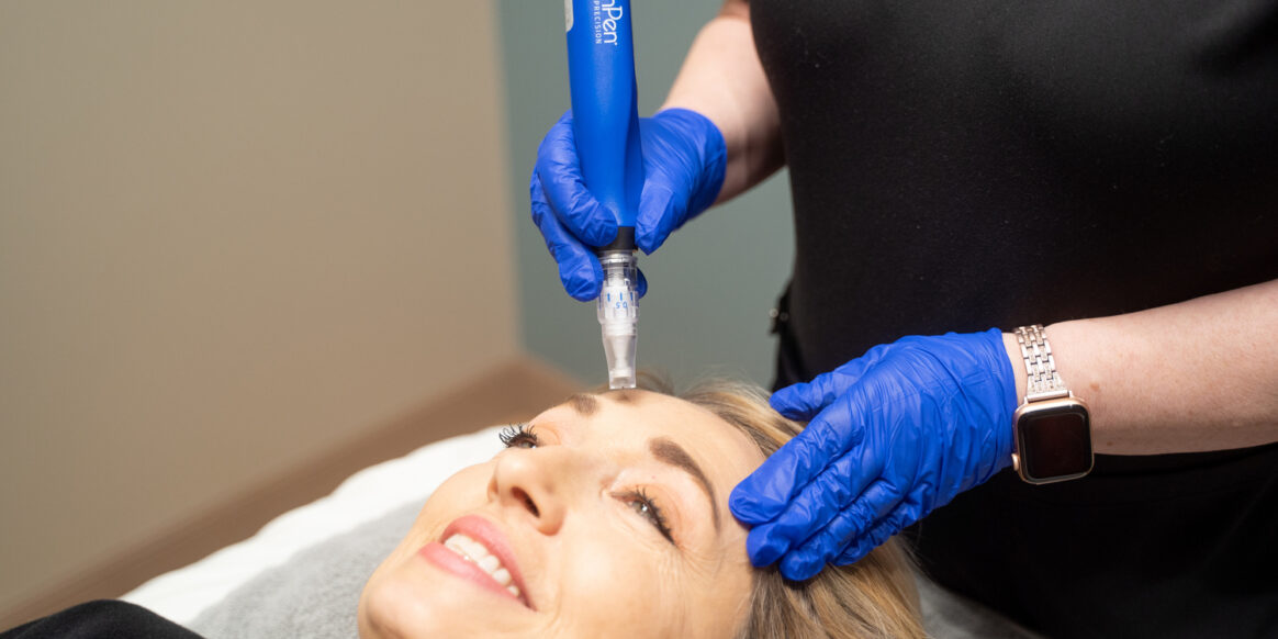 skin pen being used on patient