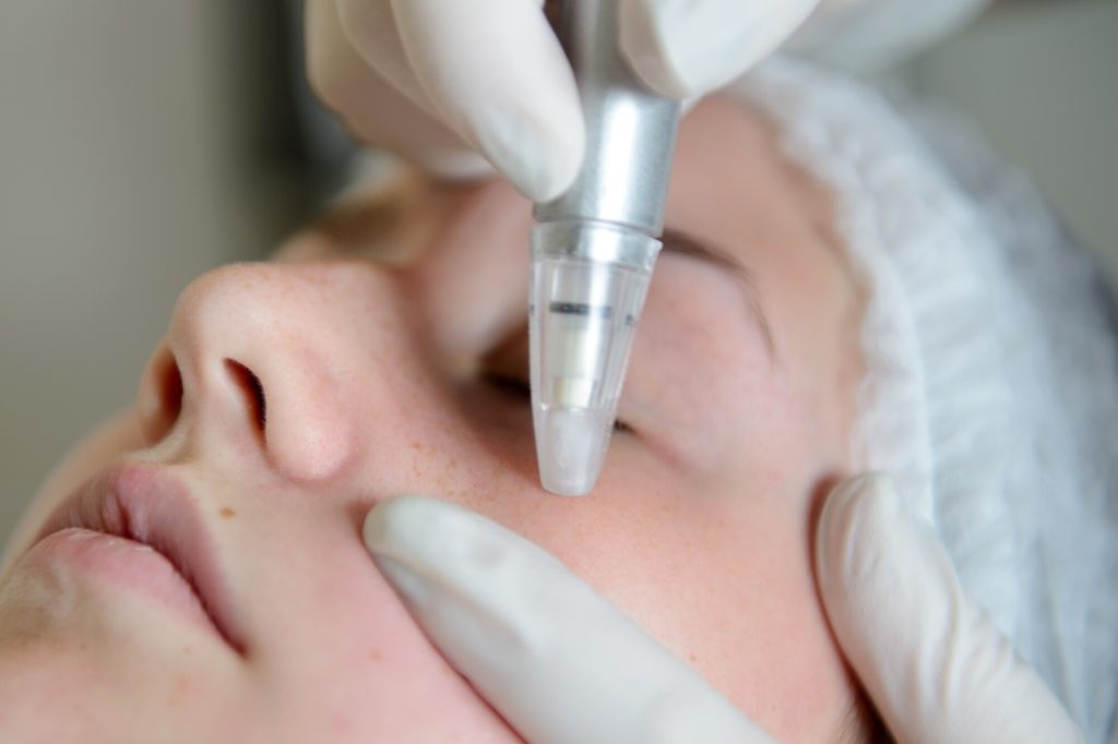 what is microneedling