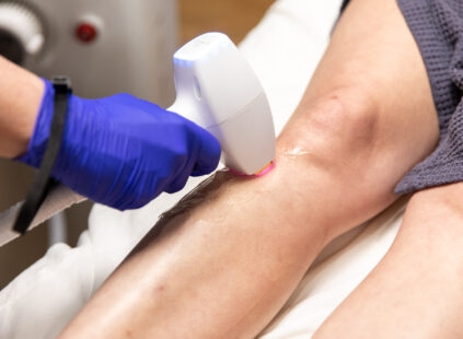 laser hair removal