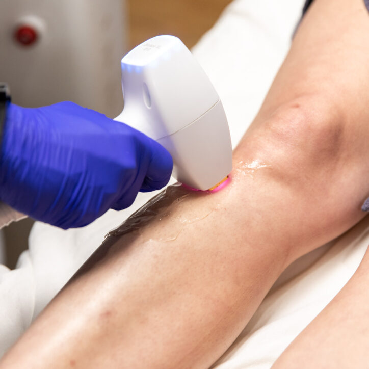 laser hair removal