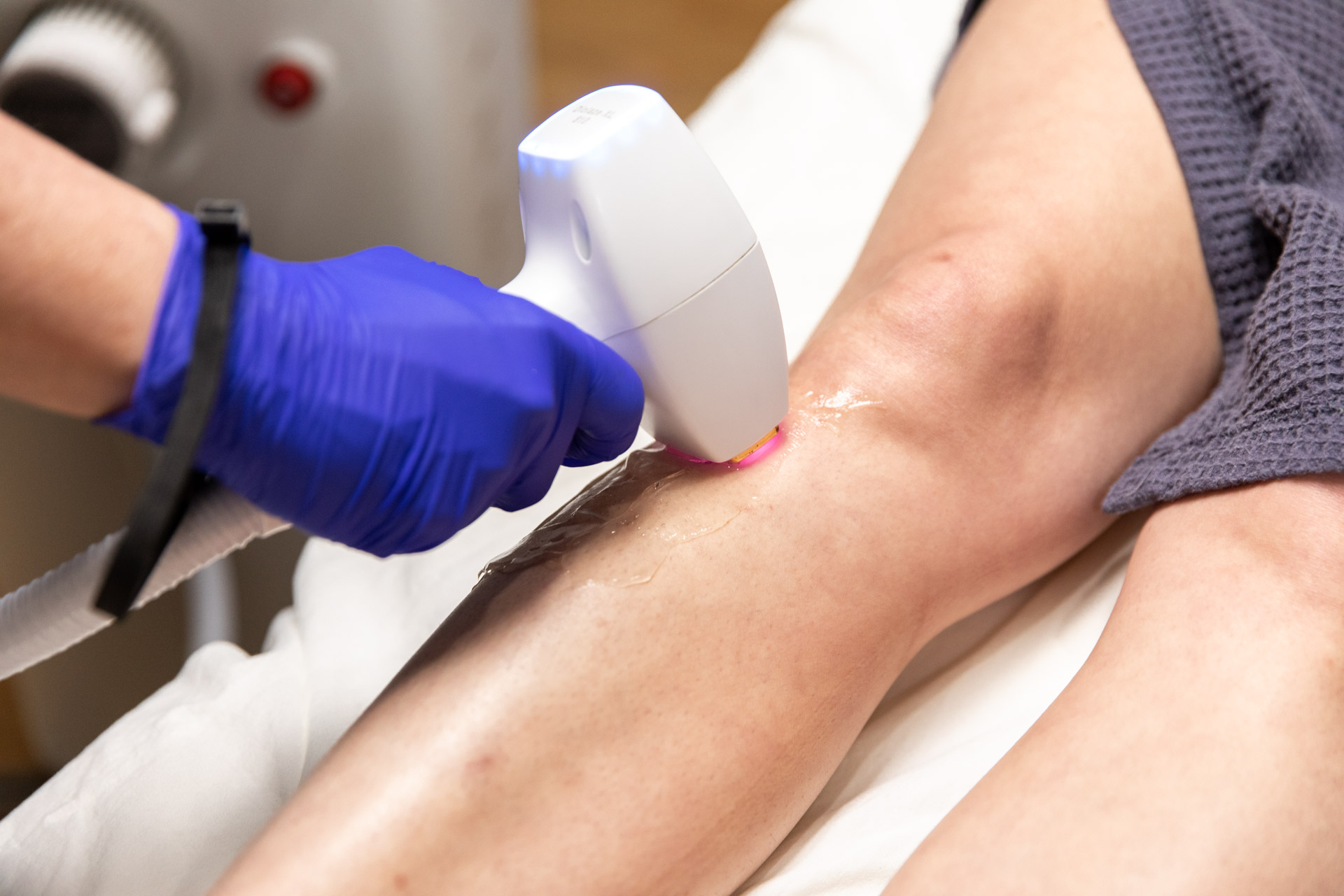 laser hair removal