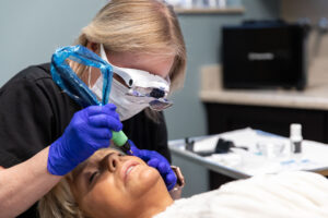 Plasma Pen treatment in St. Louis targeting fine lines and skin tightening with advanced fibroblast therapy for non-surgical facial rejuvenation.