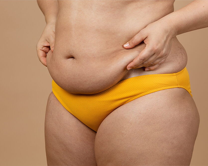 Person gently holding abdominal skin while highlighting concerns related to stomach fat or body contouring.